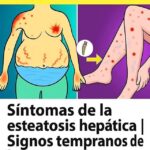 Síntomas Tempranos de la Esteatosis Hepática: Lo que Debes Saber