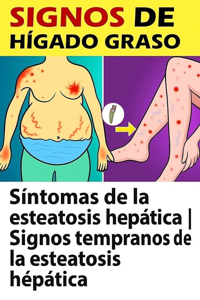Sintomas de Esteatosis Hepática