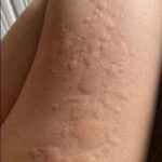 ¿Qué Hacer si Tienes Picazón y Salpullido en la Piel?