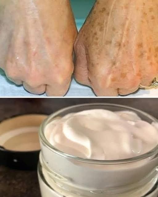Antes y Después del Uso de Crema Facial Casera