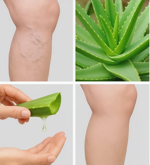 Proceso de aplicación de aloe vera en venas varicosas