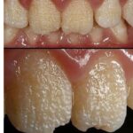 Cuidados Dentales: Remedios Naturales para la Salud Oral