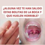 Todo lo que Necesitas Saber sobre los Tonsilolitos: Causas, Síntomas y Remedios Naturales