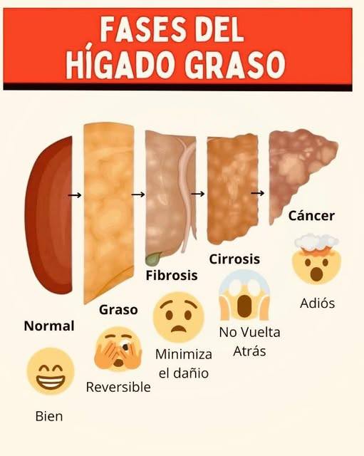 Fases del Hígado Graso