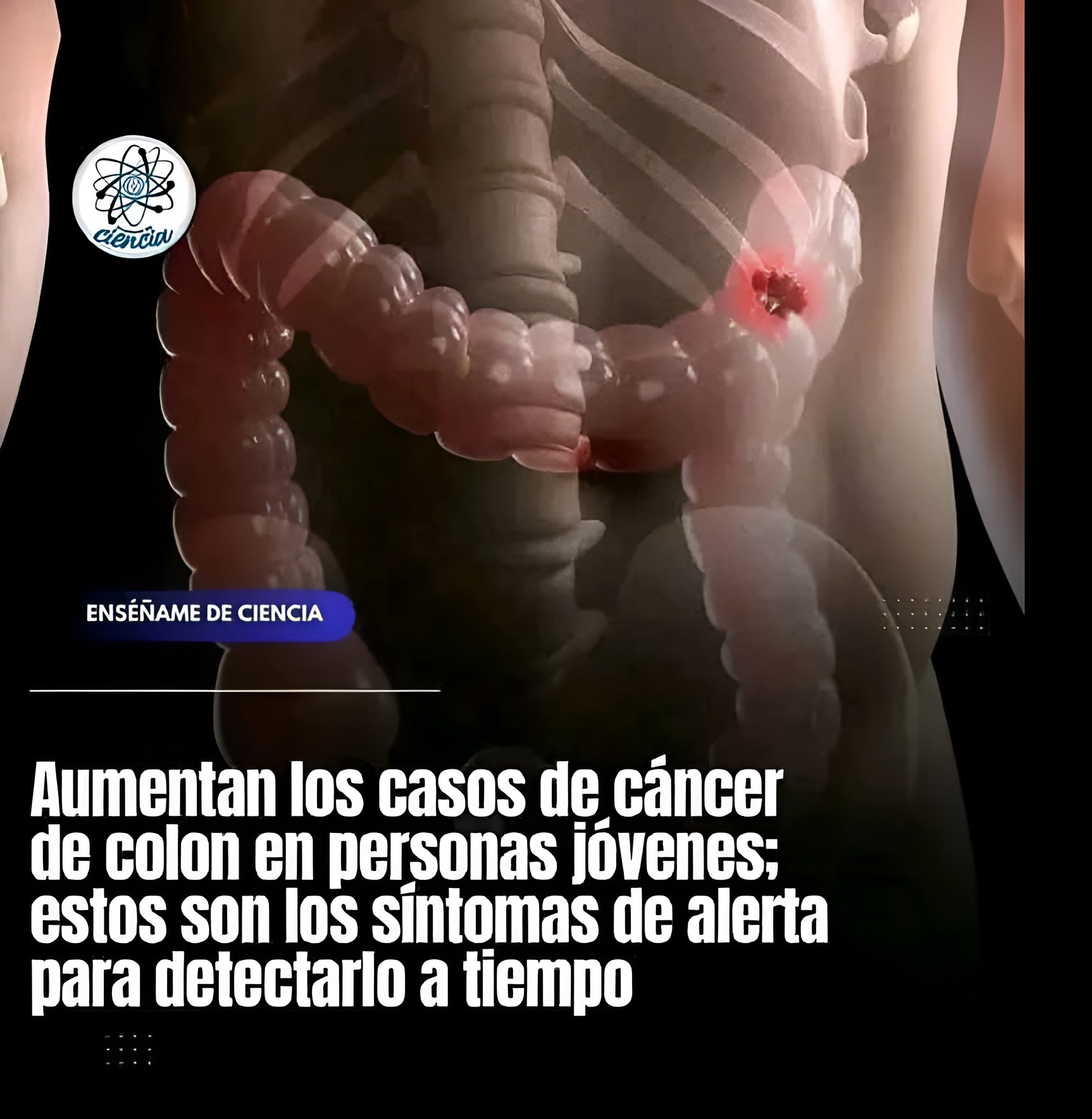 Síntomas de cáncer de colon