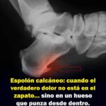 Espolón Calcáneo: El Dolor Oculto en tu Pie