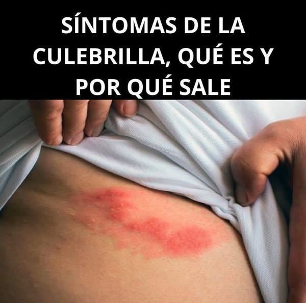 Síntomas de la Culebrilla