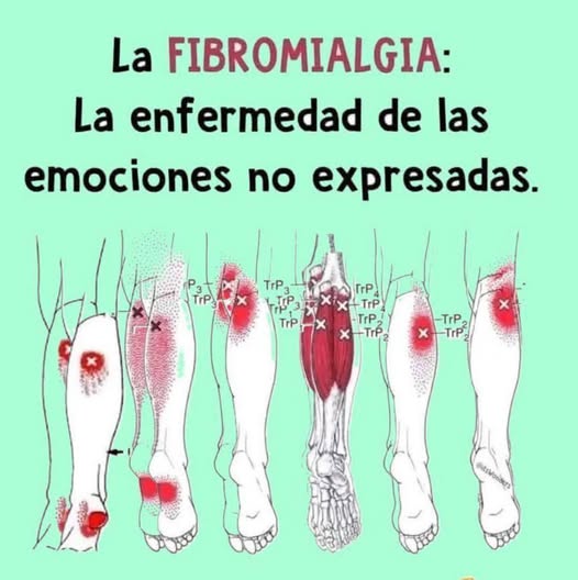 Fibromialgia: Puntos de dolor en el cuerpo