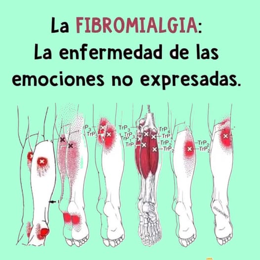 Ilustración de puntos de dolor en la fibromialgia