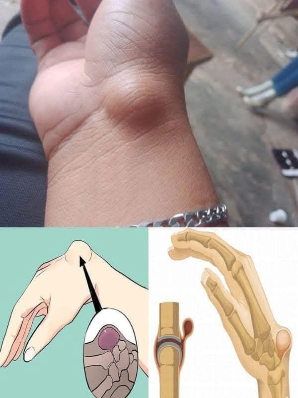 Quiste Sinovial en muñeca