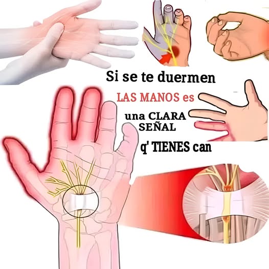 Ilustración de manos enrojecidas y diagramas de nervios