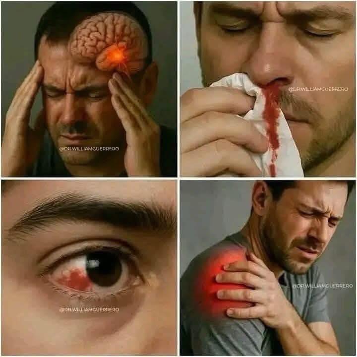 Síntomas de Aneurisma