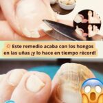 El Poder del Ajo: El Remedio Natural para Acabar con los Hongos en las Uñas