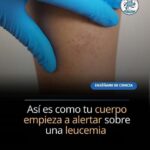 Síntomas de cáncer en la sangre: no los pases por alto
