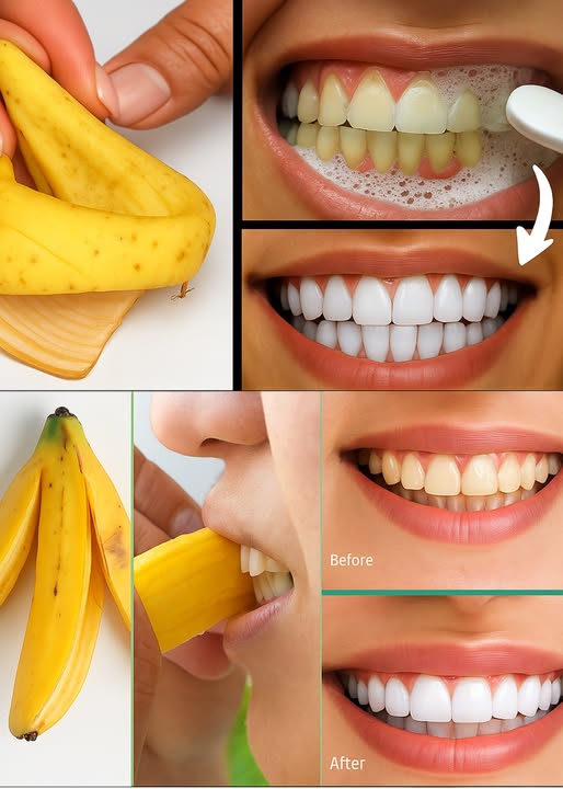 Proceso de Blanqueamiento Dental con Cáscara de Plátano