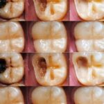 Cómo Reparar una Caries de Forma Natural: Consejos Esenciales