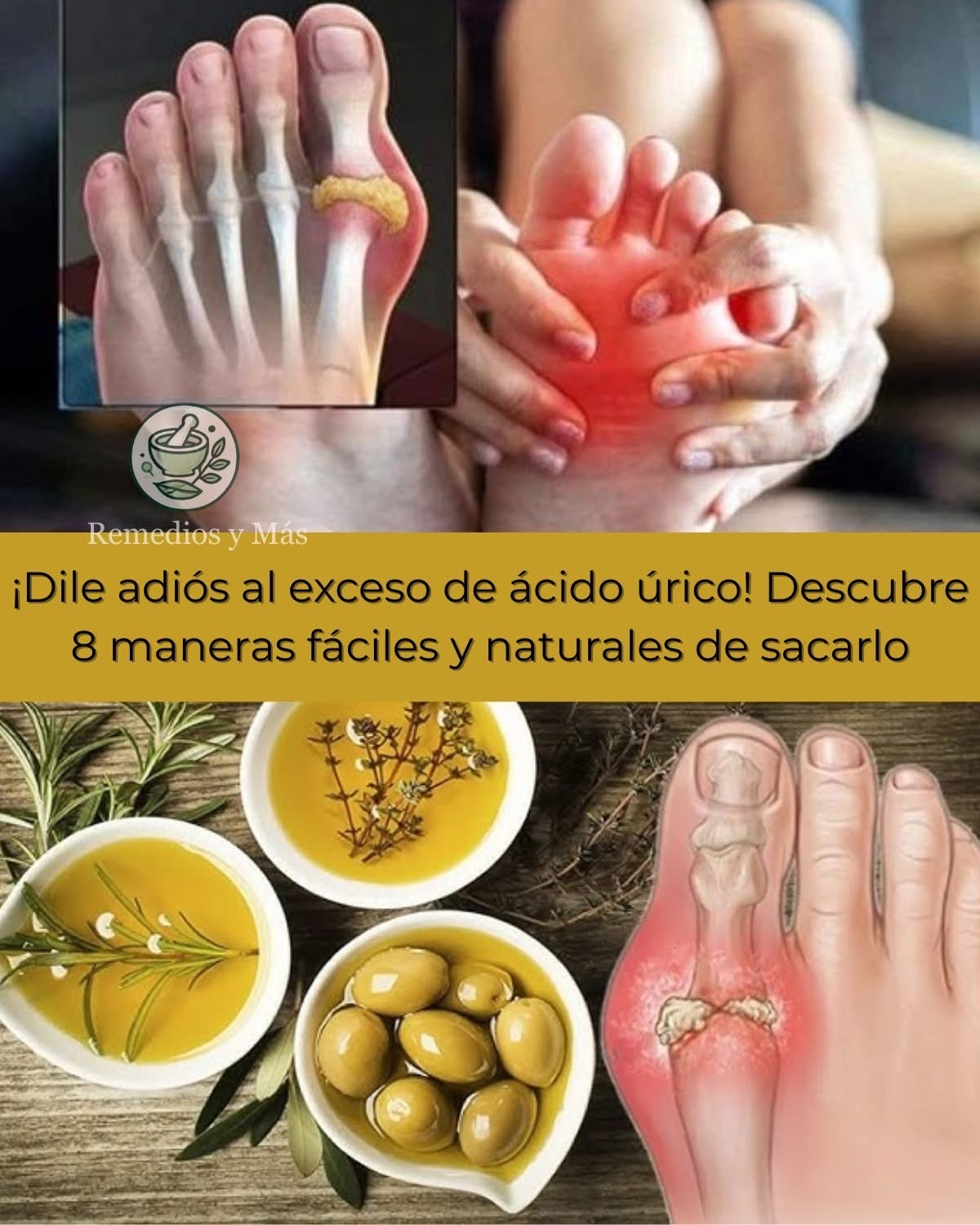 Remedios naturales para reducir el exceso de ácido úrico