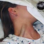 Distensión Yugular Masiva: Un Signo de Alarma que No Debes Ignorar