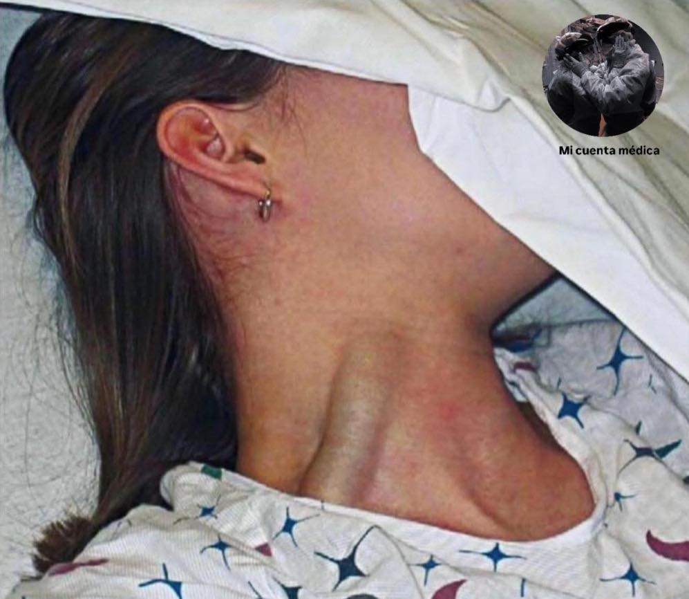 Distensión yugular masiva en un entorno médico