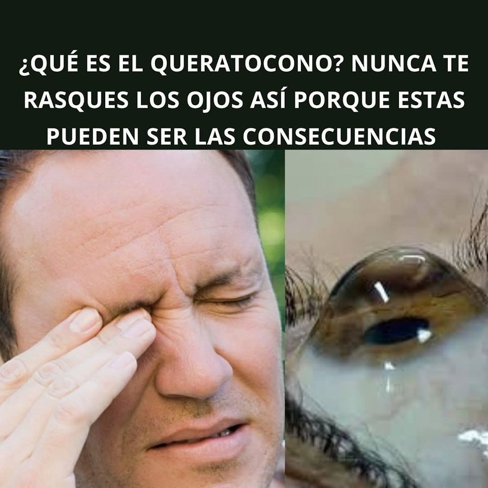 Queratocono