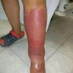 Primeros Síntomas de Afecciones Médicas y Remedios Naturales