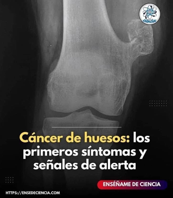 Radiografía de hueso relacionado con cáncer de huesos