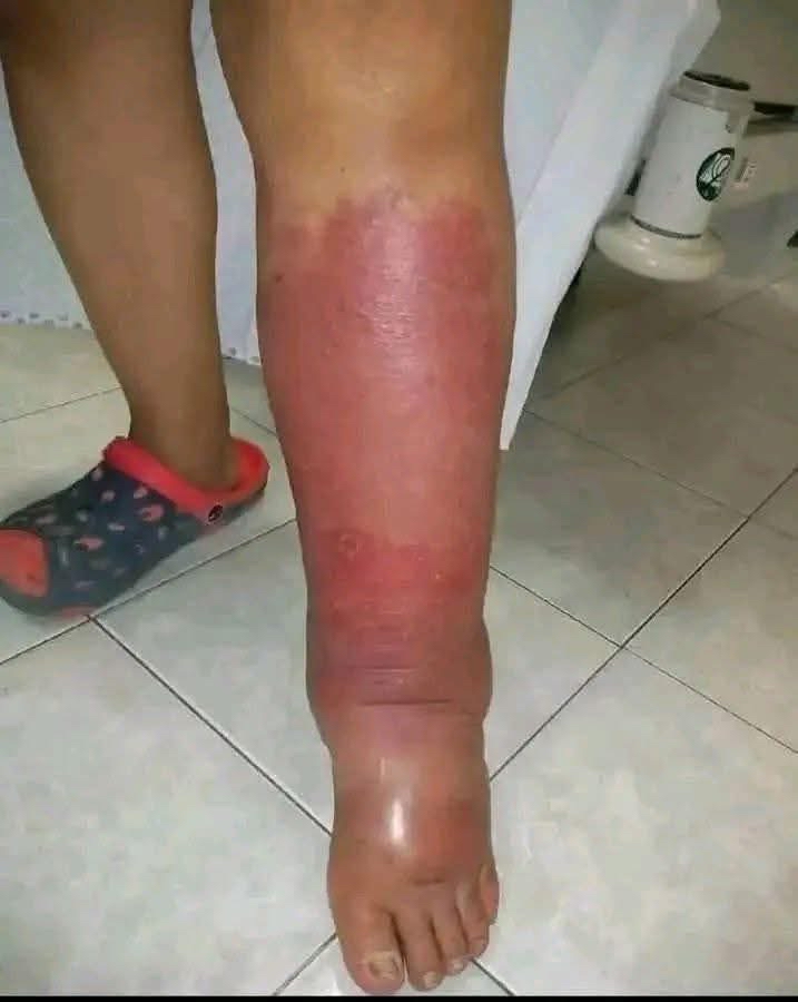 Pierna con enrojecimiento e hinchazón