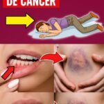 10 Señales Tempranas de Cáncer que No Puedes Ignorar
