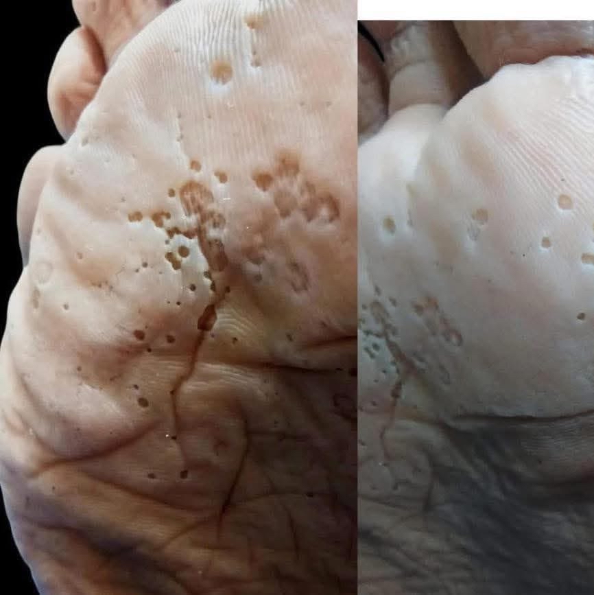 Lesiones en la piel de un pie