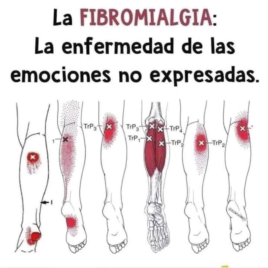 Gráfico de áreas afectadas por fibromialgia