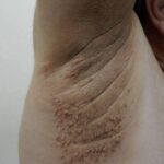 Primeros Síntomas de Afecciones Cutáneas y Remedios Naturales