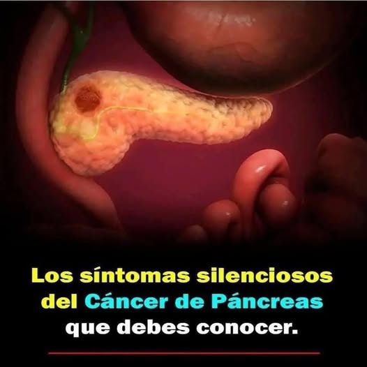 Ilustración del páncreas y el cáncer de páncreas