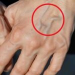 Cómo Combatir las Venas Visibles: Remedios Naturales y Consejos de Salud