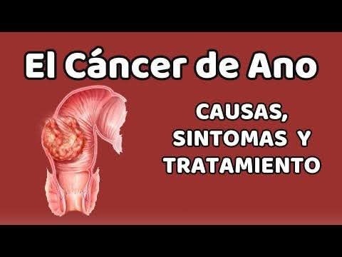 Ilustración del Cáncer de Ano