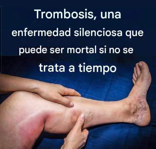 Trombosis, una enfermedad silenciosa