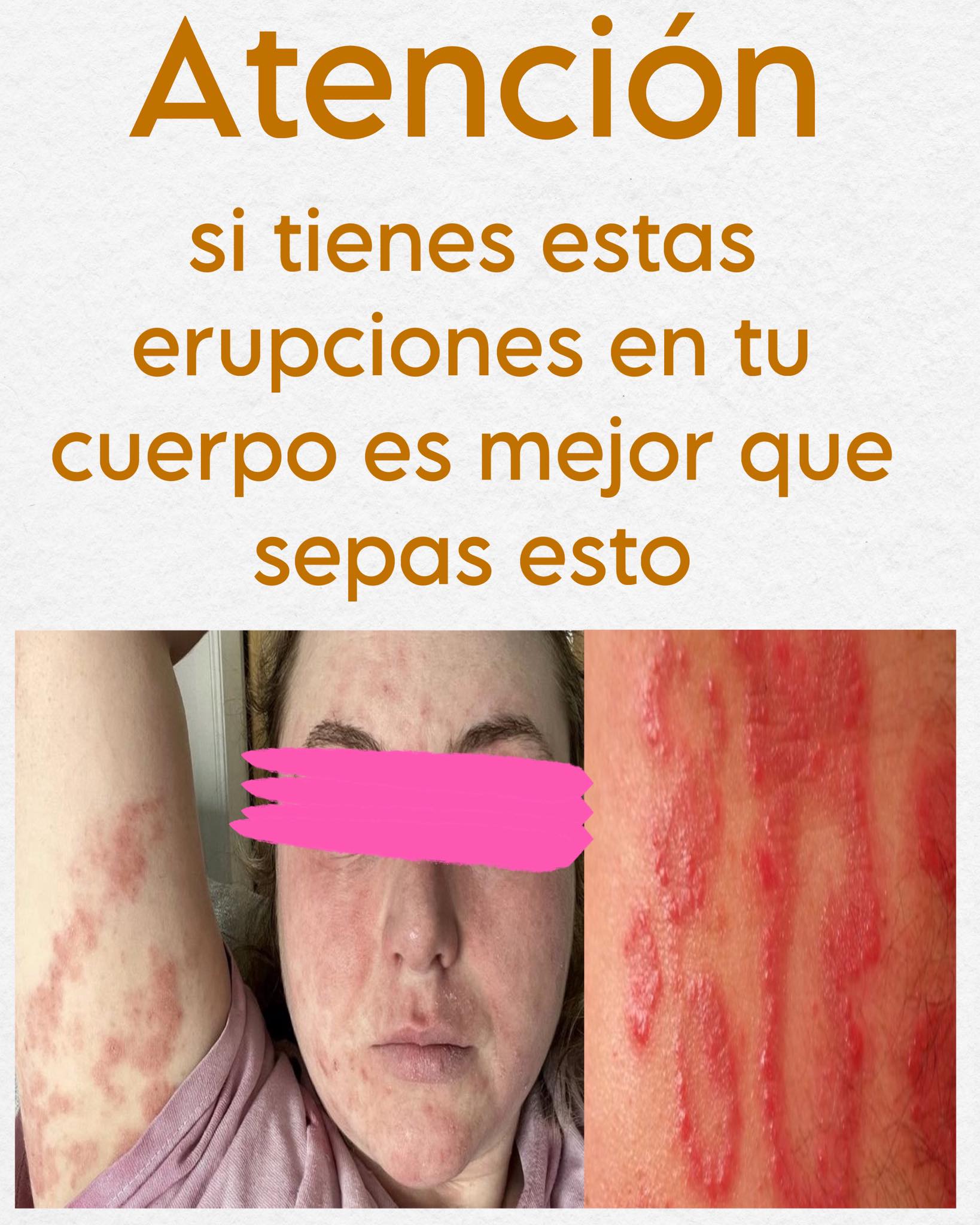 Erupciones de Herpes Zóster