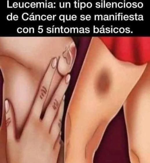 Síntomas de la leucemia