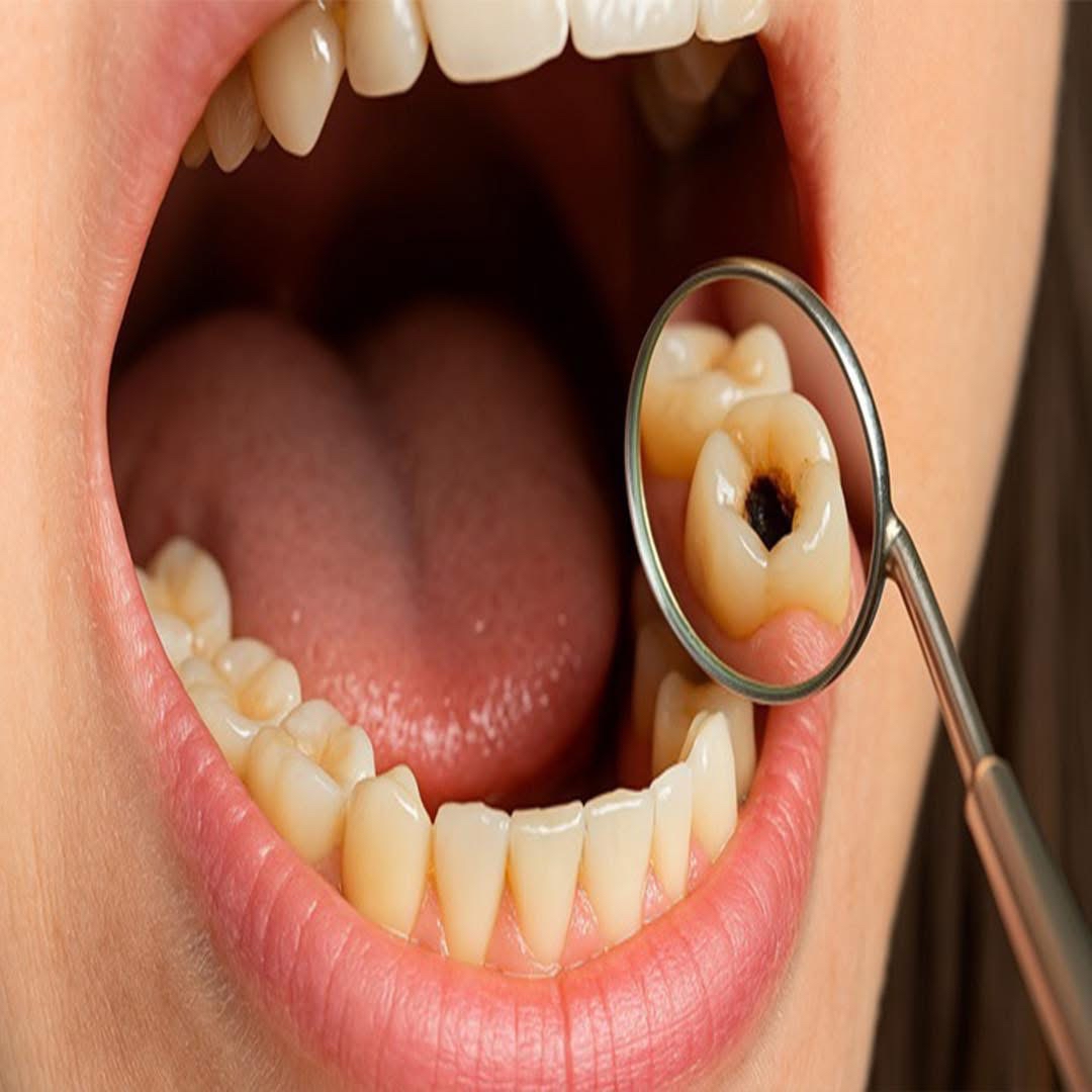 Exploración dental con caries