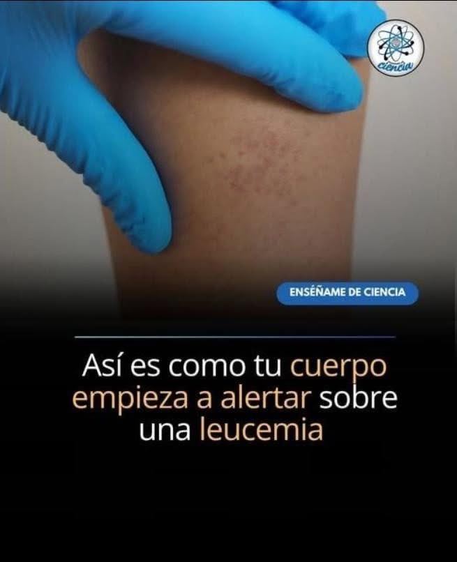 Síntomas de leucemia en la piel