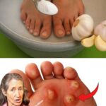 Dile Adiós a las Verrugas Plantar Con Ajo y Estos Ingredientes Caseros