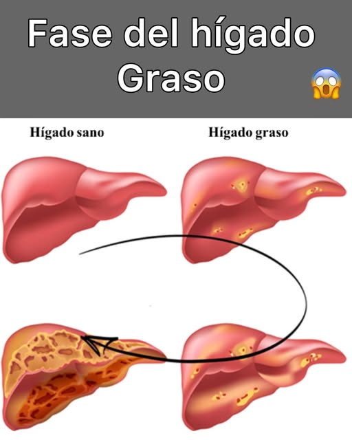 Fases del Desarrollo del Hígado Graso