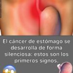 Cáncer de Estómago: Signos Tempranos y Remedios Naturales