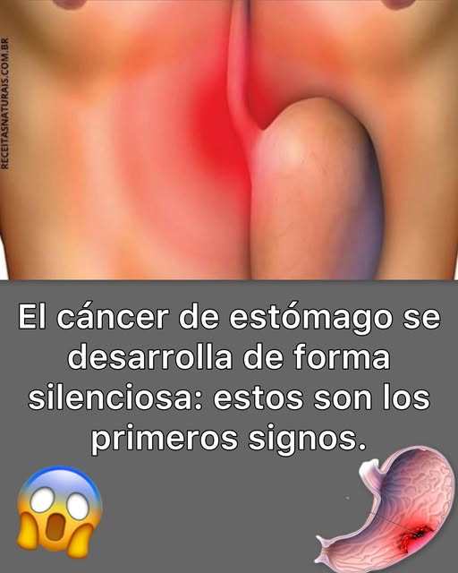 Ilustración del estómago humano con advertencia sobre el cáncer de estómago