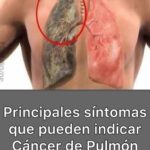 Síntomas de Cáncer de Pulmón: Identificación y Prevención