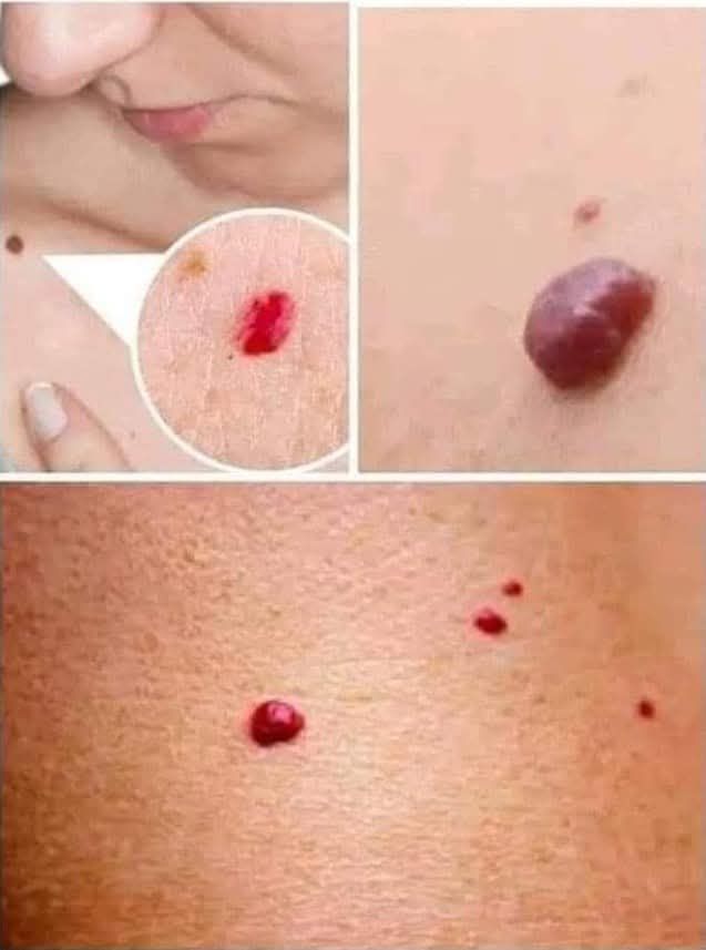 Ejemplos de marcas rojas en la piel