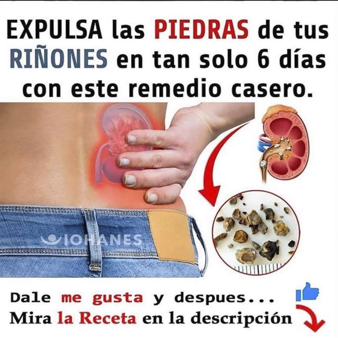 Ilustración de piedras en los riñones