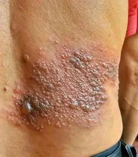 Erupción de herpes zóster