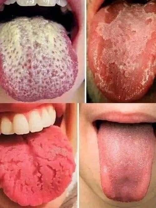 Tipos de lenguas y sus condiciones de salud