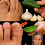 Remedio Casero para Hongos en las Uñas: Ajo y Aloe Vera