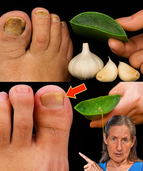 Remedio casero para hongos en las uñas utilizando ajo y aloe vera